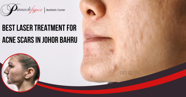laser treatment for acne scars laser treatment for acne scars