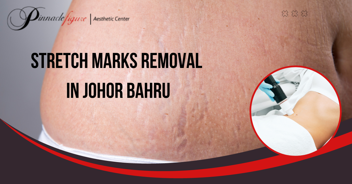 Laser stretch mark removal