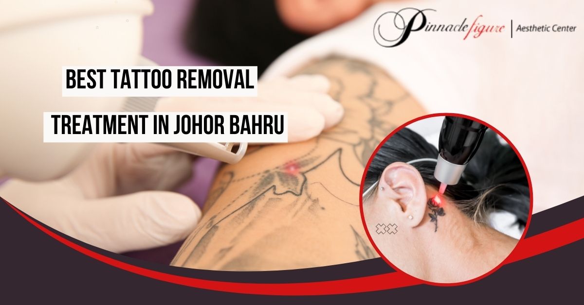 tattoo-removal-jb