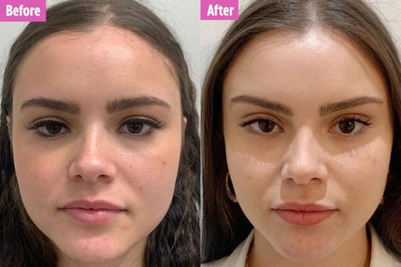 Thread Face Lift Treatment