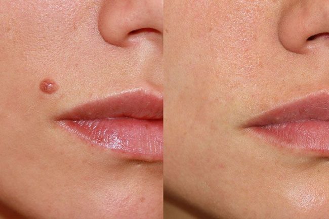 Laser Mole Treatment in Malaysia